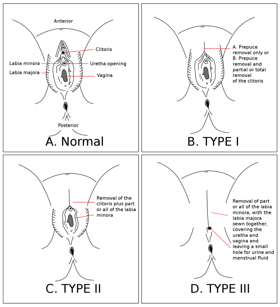 Different categories of Female Genital Mutilation